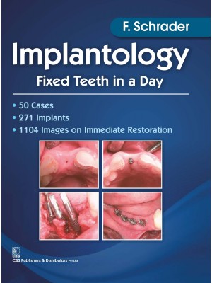 Implantology Fixed Teeth in a Day (PB)