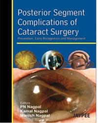 Posterior Segment Complications of Cataract Surgery|1/e