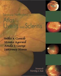 Sankara Nethralaya's Atlas of Uveitis and Scleritis|1/e