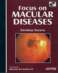 Focus on Macular Diseases (with DVD-ROM)|1/e