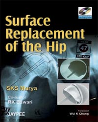 Surface Replacement of The Hip with DVD-ROM|1/e