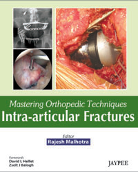 Mastering Orthopedic Techniques Intra-Articular Fractures|1/e