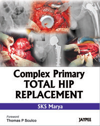 Complex Primary Total Hip Replacement|1/e