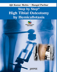 Step by Step High Tibial Osteotomy by Hemicallotasis|1/e