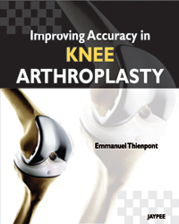 Improving Accuracy in Knee Arthoplasty|1/e
