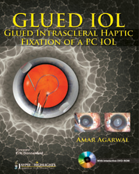 Glued IOL: Glued Intrascleral Haptic Fixation of a PC IOL|1/e