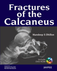 Fractures of the Calcaneus|1/e