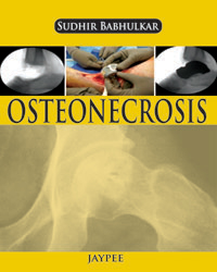 Osteonecrosis|1/e