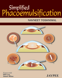 Simplified Phacoemulsification|1/e