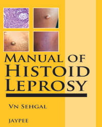 Manual of Histoid Leprosy|1/e