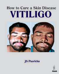 How to Cure a Skin Disease Vitiligo|1/e