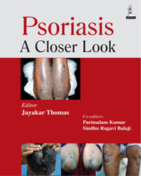 Psoriasis: A Closer Look|1/e