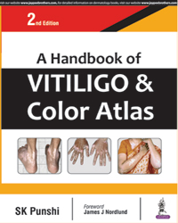 A Handbook of Vitiligo and Color Atlas|2/e