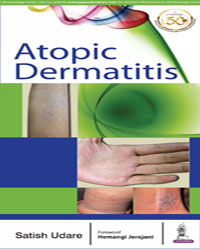 Atopic Dermatitis|1/e