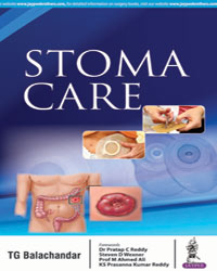 Stoma Care|1/e