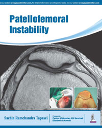 Patellofemoral Instability|1/e