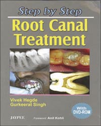 Step by Step Root Canal Treatment with DVD-ROM 1/e