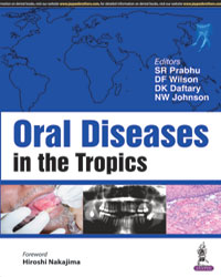 Oral Diseases in the Tropics 1/e