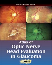 Atlas of Optic Nerve Head Evaluation in Glaucoma|1/e
