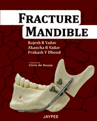 Fracture Mandible|1/e