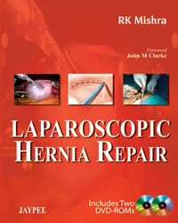 Laparoscopic Hernia Repair|1/e