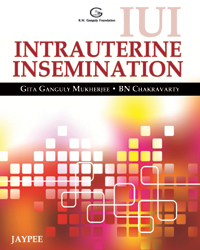IUI Intrauterine Insemination|1/e