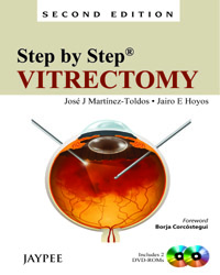Step by Step Vitrectomy |2/e