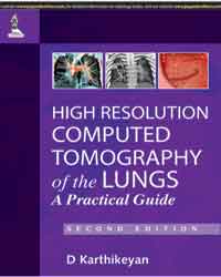 High Resolution Computed Tomography of the Lungs: A Practical Guide|2/e