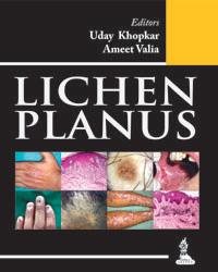 Lichen planus|1/e