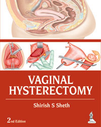 Vaginal Hysterectomy|2/e
