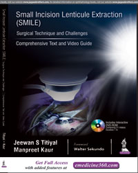 Small Incision Lenticule Extraction (SMILE): Surgical Technique and Challenges (Comprehensive Text and Video Guide)|1/e